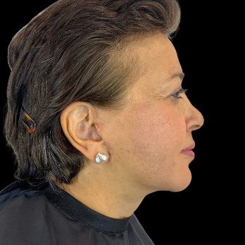 after-deep-plane-facelift-necklift-chin-implant